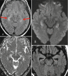 Fig. 6.7. Axial FLAIR (a) shows bilateral high signal in the hippocampus.