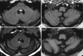 Fig. 6.8. Initial MR exam in a patient with proven anti-Yo encephalitis (a, b).