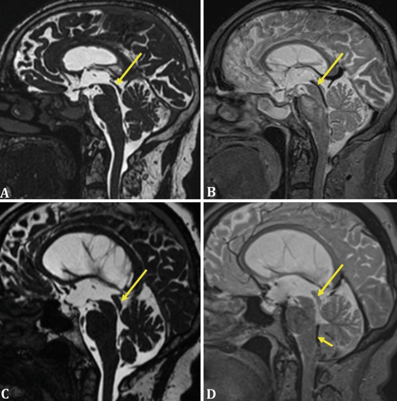 Fig. 2.4. Brain MRI in a patient with communicating hydrocephalus (a, b) and in a patient with a non-communicating hydrocephalus secondary to aqueductal stenosis (c, d).