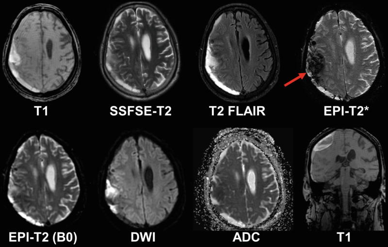 subdural hematoma mri