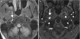 Fig. 16.12. (a) Axial flair sequence shows crescentic shaped mural hyperintensity along the medial right ICA wall (arrow), expanding the caliber of the ICA, but only minimally narrowing the lumen.