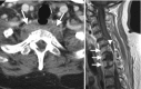 Fig. 16.16. (a) Axial CECT shows enlargement and heterogeneous enhancement in the prevertebral space involving the prevertebral muscles and abutting the T2 vertebral body.