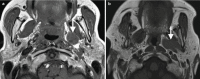 Fig. 16.3. (a) Primary BMT of the left PPS is surrounded entirely by fat on axial T1-weighted image.