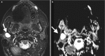 Fig. 16.6. (a) Axial STIR image demonstrates marked T2 prolongation of a well-defined mass in the right parotid superficial lobe found to represent a benign mixed tumor.