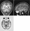 Fig. 10.12. (a–c) Periventricular nodular heterotopia: (a) coronal T1; (b) sagittal T2; (c) axial T1IR.