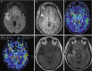 Fig. 10.15. Right superior temporal gyrus ganglioglioma in a middle-aged patient.