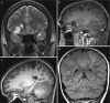 Fig. 10.16. Two patients with DNET.