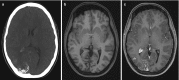 Fig. 10.21. (a–c) Sturge–Weber syndrome; (a) axial CT shows curvilinear cortical calcifications in the right occipital lobe; (b) axial T1 without and (c) with gadolinium shows contrast enhancement caused by pial angiomatosis.