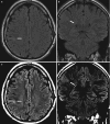 Fig. 10.5. (a, b) Right lateral precentral gyrus type II FCD.