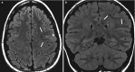 Fig. 10.9. Left frontal type II FCD.