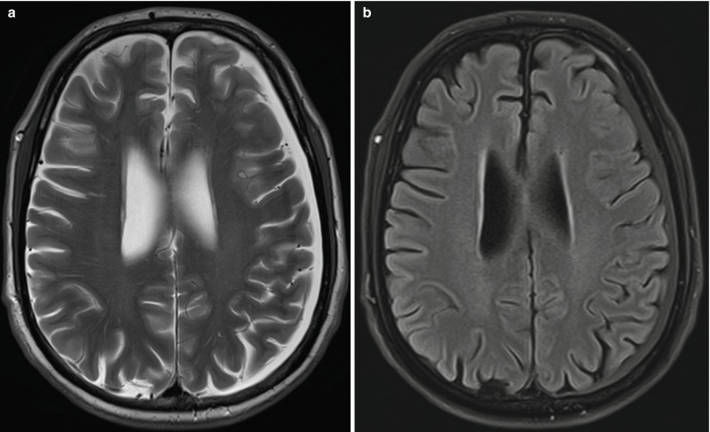 subdural hematoma mri