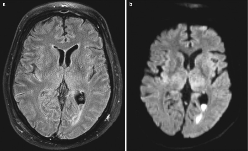 subarachnoid hemorrhage mri