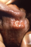 This was an outbreak of herpes genitalis, which had manifested as blistering on the underside of the penile shaft, just proximal to the corona of the glans, which was due to the herpes simplex 2 (HSV-2) virus, otherwise referred to as genital herpes
