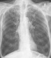 X-ray, Chest, Chronic Obstructive Pulmonary Disease, COPD, Anterior Contributed by chestatlas