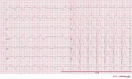 EKG showing accelerated idioventricular rhythm in a patient who was treated with primary PCI