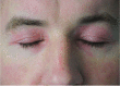 Dermatomyositis rash Photograph courtesy of Dr Mark Tarnopolsky, McMaster University, Hamilton, Canada