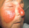 Erysipelas rash By CDC/Dr