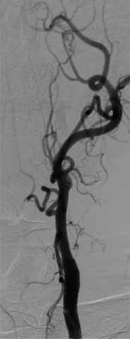 Occlusion of the Internal Carotid Artery (ICA)