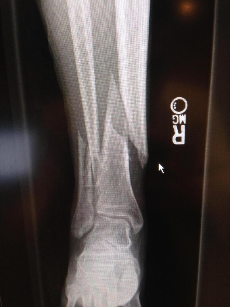 spiral fracture of tibia and fibula recovery time