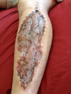 Fasciotomy to treat acute compartment syndrome. : r/FOAMed911