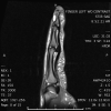 STIR sagittal image of the left index finger demonstrates a markedly hyperintense subungual mass