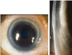 Figure 1: The images are showing peripheral corneal thinning on slit lamp examination in a patient with Furrow Degeneration