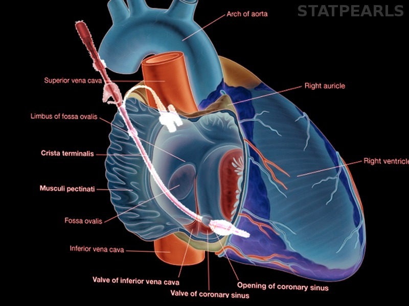 [Figure, Retrograde cardioplegia Image courtesy S Bhimji MD