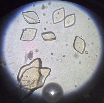 crystals in human urine