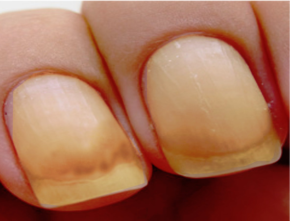 Born Pretty 3ml Fungus Treatment Nail Oil Pen Anti-fungal Nail Cuticle  Remover | Fruugo AE