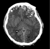 Brain Trauma Computed Tomography