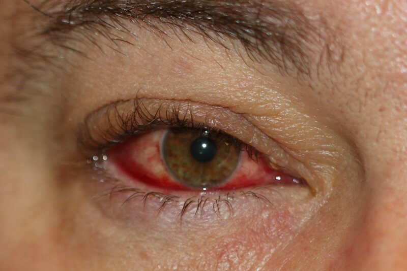 Figure Blepharoconjunctivitis With Inflammation Of The Statpearls Ncbi Bookshelf 