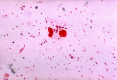 Gram Stain, dipplococcus, Gonorrhea, Contributed by Dr