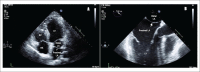 Figure 1 A) Transthoracic echocardiogram showing cor triatriatum: proximal and distal left atrium separated by a membrane (Pointing white arrow), LA: left atrium; LV: left ventricle; RV: right ventricle; RA: right atrium