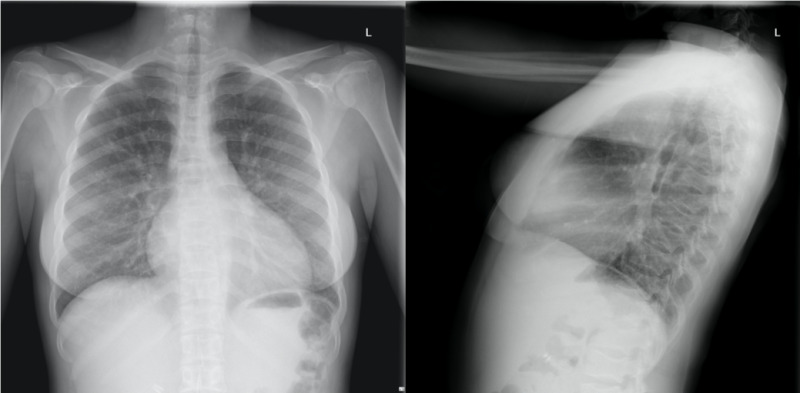 lateral chest xray
