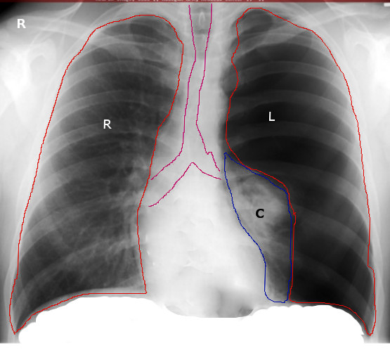 Left Tension Pneumothorax Radiograph