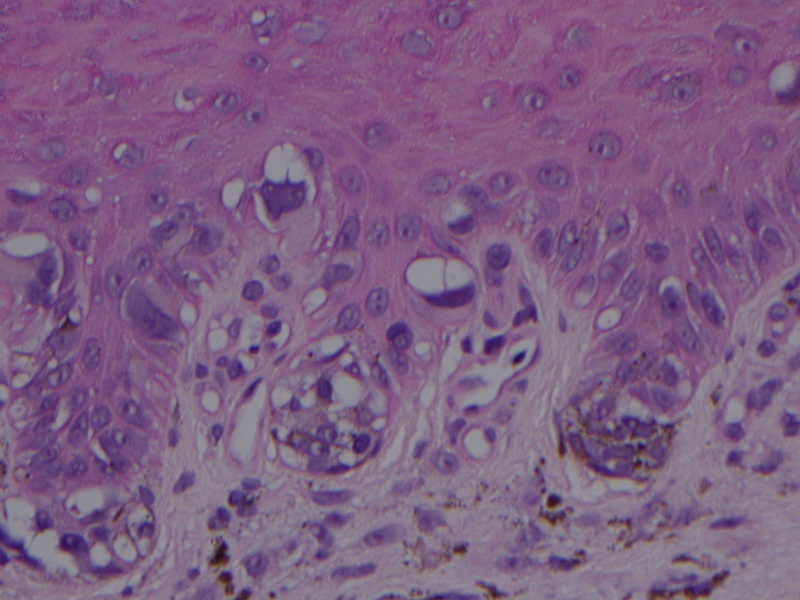 acral lentiginous melanoma histology