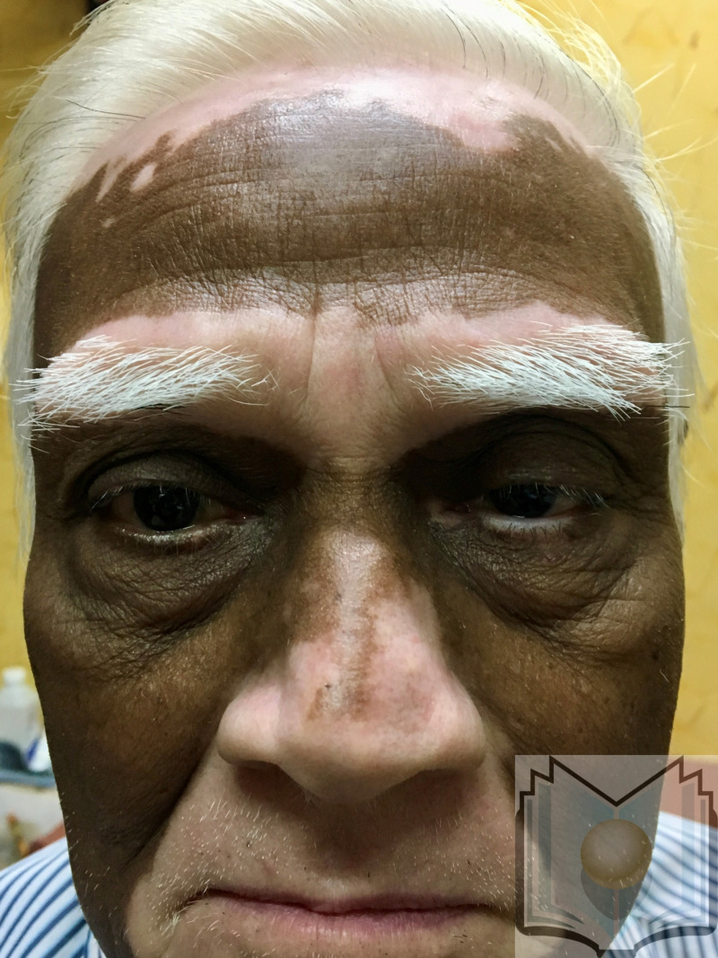 Vitiligo, Facial Contributed by Dr