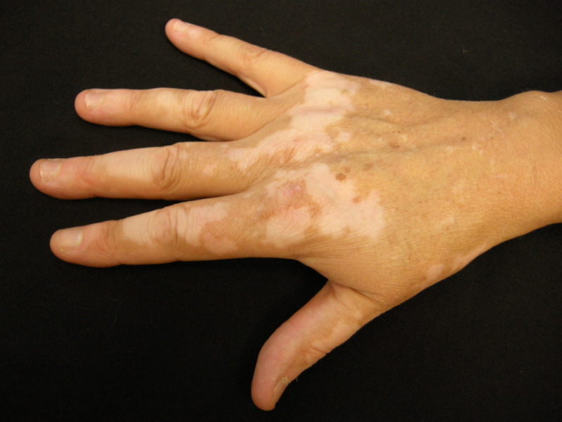 Image vitiligo