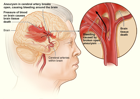 Nursing Paper Example on Cerebral Aneurysm: A Comprehensive Overview