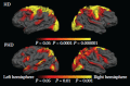 FIGURE 11.1. Cortical changes occur early and are extensive in HD.