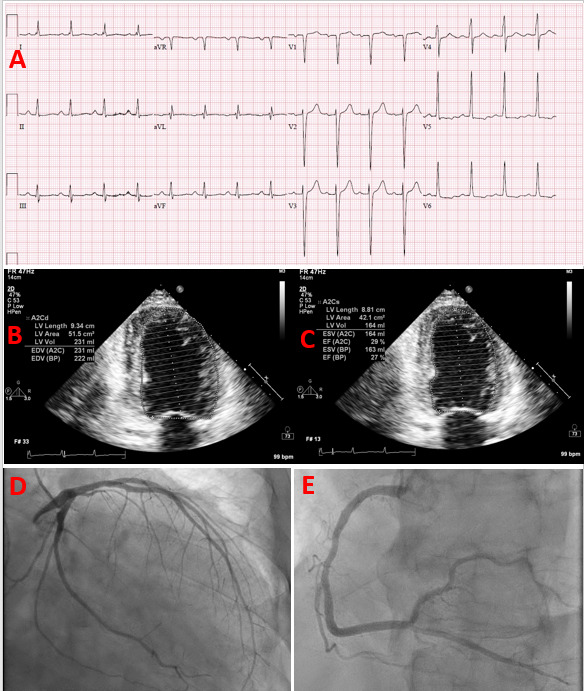 Left ventricular global systolic dysfunction has a significant role in the  development of diastolic heart failure in patients with systemic  hypertension