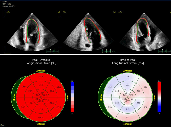 JACC Journals on X: Easing the strain of family screening in dilated  #cardiomyopathy (DCM). New #JACCIMG study finds #EchoFirst global  longitudinal strain adds prognostic value beyond normal #LVEF for  asymptomatic relatives of