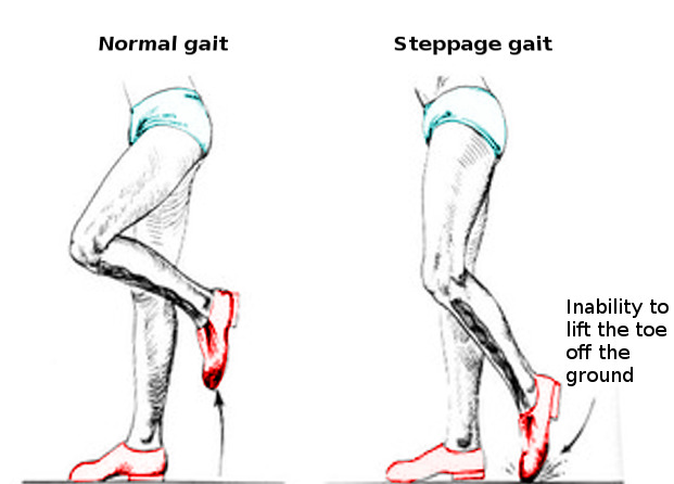 Gait Disturbances - StatPearls - NCBI Bookshelf