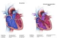 Diagram comparing a normal heart to a heart with atrioventricular septal defects
