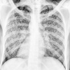 Miliary Tuberculosis Radiography