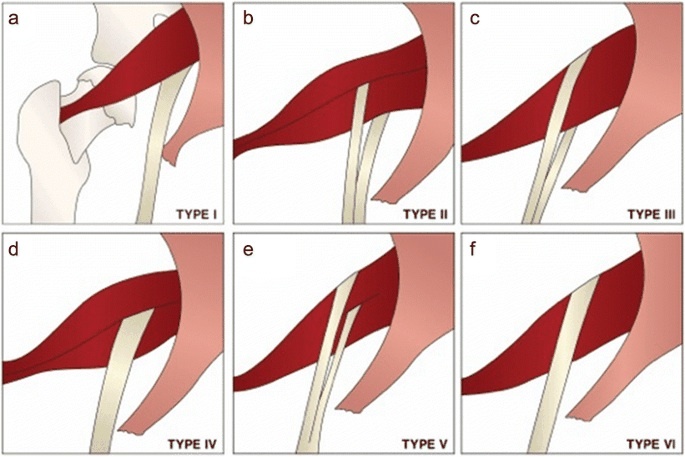 Diagnosis and Management of Piriformis Syndrome: An Osteopathic