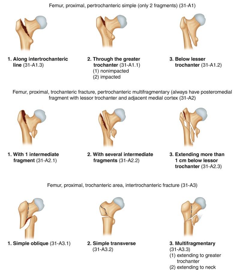 intertrochanteric fracture classification