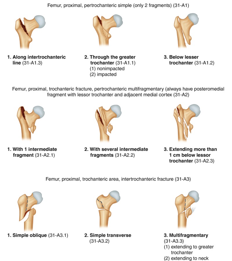 Fig. 9.3, [AO/OTA Classification for trochanteric fractures (Reproduced ...