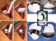 Fig. 19.6. Before the final implantation, 3D-printed nylon trial components are used for trialing (a), once implants are cemented, different thicknesses of polyethylene liners are trialed for proper ligament tensioning (b), and final liner is inserted and locked in place (c, d).