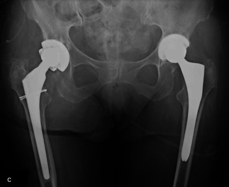 Fig. 12.5, [Standard low AP pelvis, following first revision